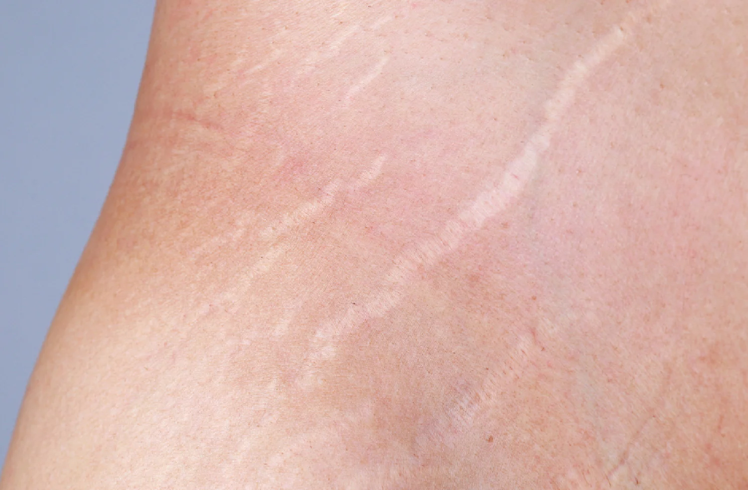 أسباب علامات تمدد الجلد والحلول